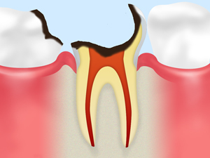末期の虫歯