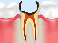 重度の虫歯の抜歯